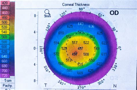 ocular measure thickeness|pachymetric test for corneal pressure.